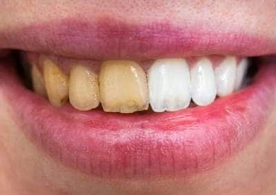 அருவெறுப்பான மஞ்சள் பற்கள் முத்து போல் ஜொலிக்க இந்த வீட்டு வைத்தியம் பயன்படுத்துங்க