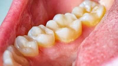 அசிங்கமான மஞ்சள் பற்கள் முத்து போல ஜொலிக்க வீட்டு வைத்தியங்கள்