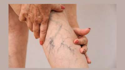 Varicose Veins: கால்களில் நரம்புகள் கதகளி ஆடுதா? இதை முதலில் படிங்க!!