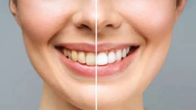 மஞ்சள் பற்கள் பளீரென மின்ன..2 நிமிஷம் ‘இதை’ பண்ணுங்க போதும்!