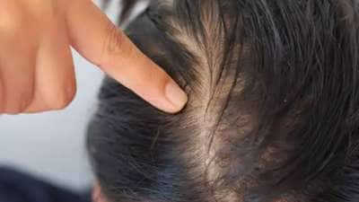 வெள்ளை முடிக்கு இயற்கை தீர்வு பெற இதை மட்டும் செய்யுங்கள்