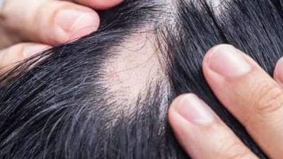 முடிக்கொட்டலை நிறுத்தும் ஹேர் பேக் ரெசிபி! வாரத்தில் 3 முறை போடுங்கள்-முடி உதிர்வை மறந்து விடுங்கள்!