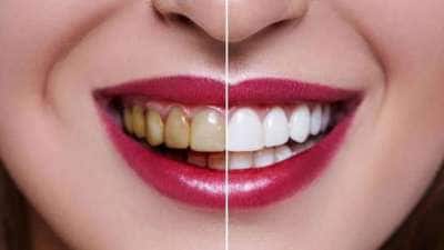 அசிங்கமான மஞ்சள் பற்கள் முத்து போல் ஜொலிக்க இதை மட்டும் செய்யுங்கள்