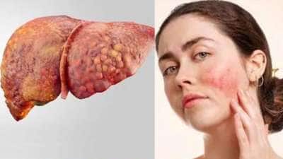 முகத்தில் இந்த அறிகுறிகள் இருந்தால் ஜாக்கிரதை: கொழுப்பு கல்லீரல் நோய் இருக்கலாம்