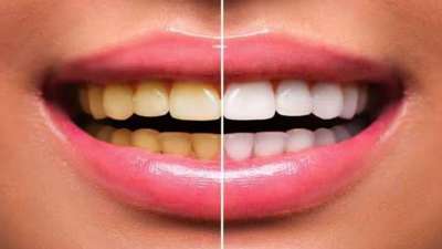 மஞ்சள் பற்கள் முத்து ஜொலிக்க இந்த ஆயுர்வேத டிப்ஸை ட்ரை பண்ணுங்க
