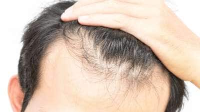 இனி வழுக்கையே வராது! நீங்கள் செய்ய வேண்டிய 'அந்த' ஒன்று இதுதான்