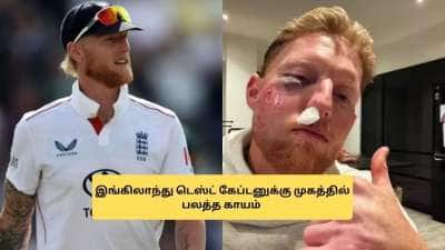 சிதைந்த பென் ஸ்டோக்ஸின் முகம்.. மருத்துவமனையில் சிகிச்சை! என்ன ஆச்சு.. வைரலாகும் போட்டோ