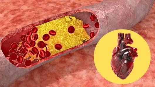 மாரடைப்புக்கு காரணமான LDL கொலஸ்ட்ராலை... எகிற வைக்கும் சில உணவுகள்