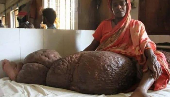 காலின் எடை மட்டும் 60 கிலோ: குழம்பும் மருத்துவர்கள்! காலின் எடை மட்டும் 60 கிலோ: குழம்பும் மருத்துவர்கள்!