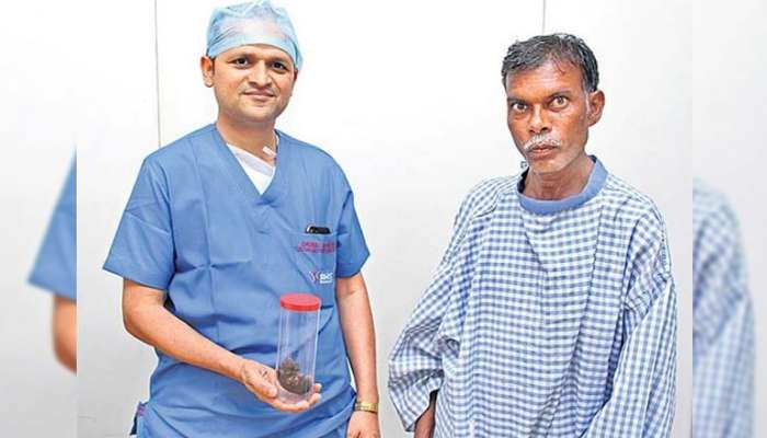 தெலுங்கானா மனிதனின் வயிற்றில் உருளைக்கிழங்கு சைஸ் சிறுநீரக கல் அகற்றம்... தெலுங்கானா மனிதனின் வயிற்றில் உருளைக்கிழங்கு சைஸ் சிறுநீரக கல் அகற்றம்...