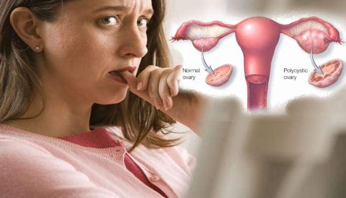 உங்களுக்கு (PCOS)இருக்கிறதா? அப்போ இதை படிக்கவும்!!