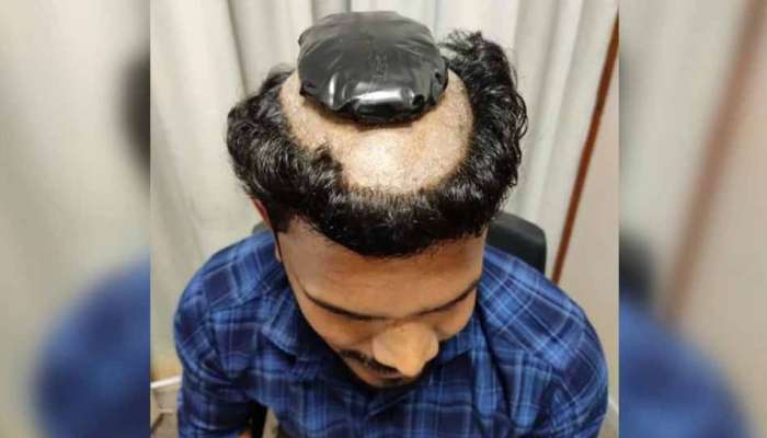தலை விக்கின் கீழ் வைத்து தங்கத்தை கடத்த முயன்ற வாலிபர் கைது!! தலை விக்கின் கீழ் வைத்து தங்கத்தை கடத்த முயன்ற வாலிபர் கைது!!