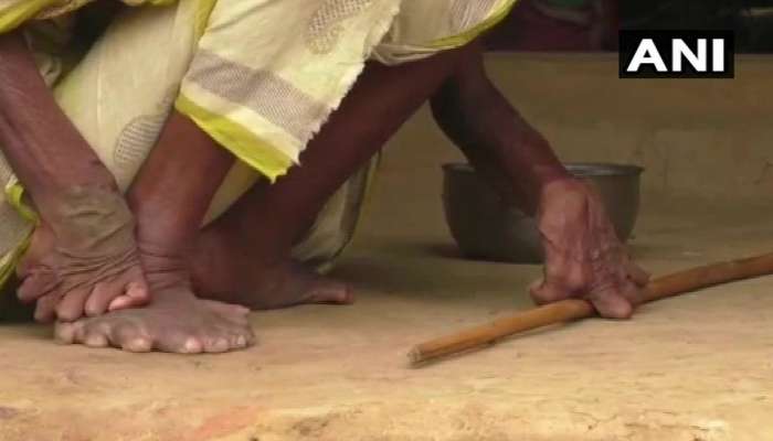 32 விரல் கொண்ட பாட்டியை சூனியக்காரி என முத்திரை குத்தி ஒதுக்கிவைத்த உறவினர்கள்..! 32 விரல் கொண்ட பாட்டியை சூனியக்காரி என முத்திரை குத்தி ஒதுக்கிவைத்த உறவினர்கள்..!