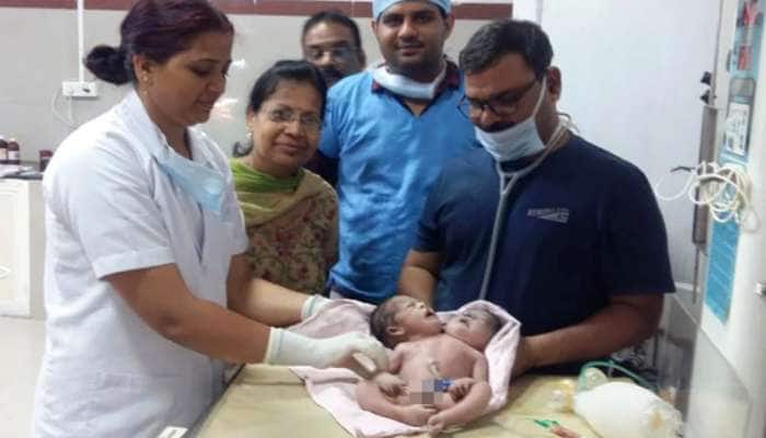 இரண்டு தலை மூன்று கைகளுடன் மத்திய பிரதேசத்தில் பிறந்த அதிசய குழந்தை!