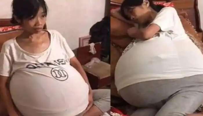 பலூன் போல பெருத்துக் கொண்டே போகும் வயிறு; மர்மமான நோய்.. அவதிப்படும் பெண்.. பலூன் போல பெருத்துக் கொண்டே போகும் வயிறு; மர்மமான நோய்.. அவதிப்படும் பெண்..