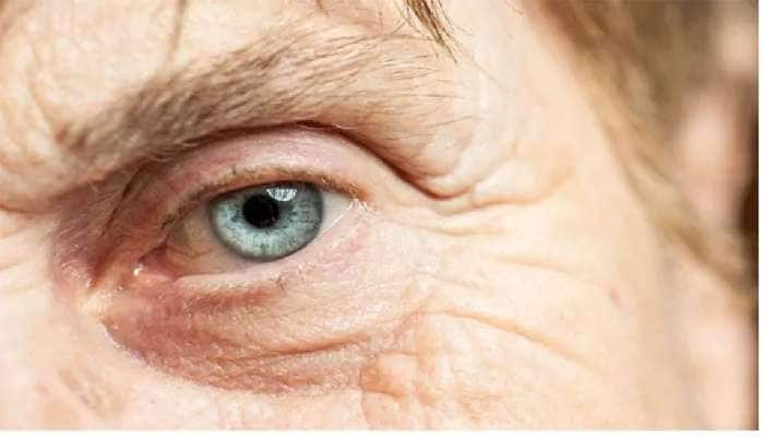 Cataract surgery: கண் அறுவை சிகிச்சைக்கு அரசு அனுமதி...!!!