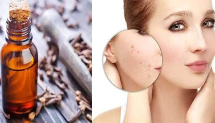 Beauty Tips: முகப்பரு, வடுக்கள் நீங்கி முகப்பொலிவு பெற கிராம்பு எண்ணெய் ஒன்று போதும் 