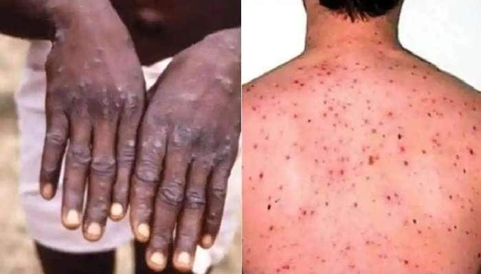 Monkeypox: 18 ஆண்டுகளுக்குப் பிறகு அமெரிக்காவை அச்சுறுத்தும் அரிய வகை நோய்