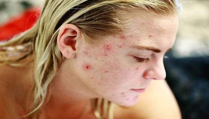 Pimples Reasons: முகப்பரு வர இதெல்லாம் கூட காரணமாகுமா?  title=