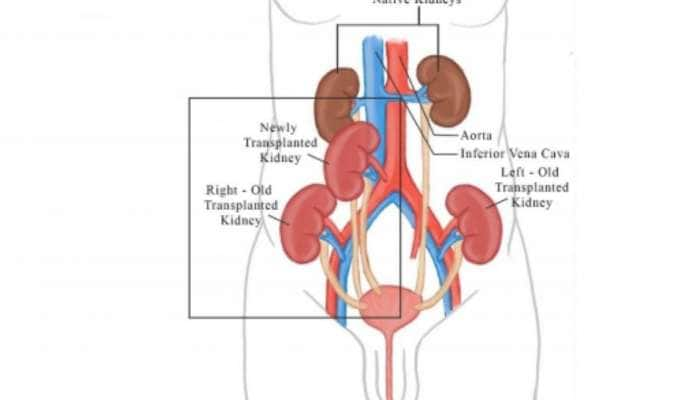 Medical Miracle: 3வது சிறுநீரக மாற்று அறுவை சிகிச்சை செய்துக் கொண்ட நோயாளி 5 சிறுநீரகங்களுடன் நலம்!!!!!