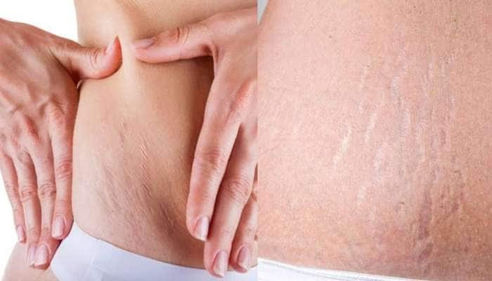 Stretch marks removal: பிரசவ தழுப்புகளை நீக்கும் ‘4’ வீட்டு வைத்தியங்கள்