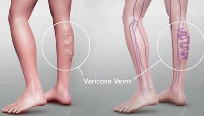 varicose veins: வெரிகோஸ் வெயின் பாதிப்பா? கவலை வேண்டாம்! இதோ நிவாரணம் title=