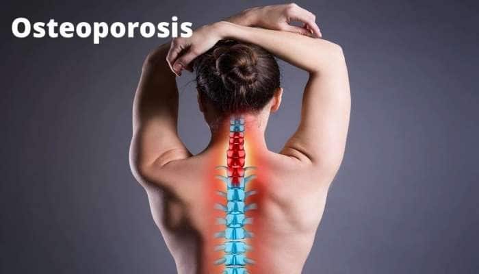Osteoporosis: எலும்பு மெலிதல் நோயிலிருந்து தப்பிக்க கடைபிடிக்க வேண்டிய விஷயங்கள்