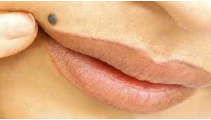 Beauty Tips: மருக்களை நீக்க எளிய இயற்கையான வழிமுறை  