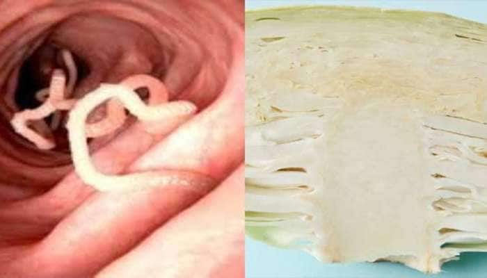 முட்டைகோஸில் உள்ள நாடாப்புழு மூளையை பாதிக்கும்; தவிர்ப்பது எப்படி! 