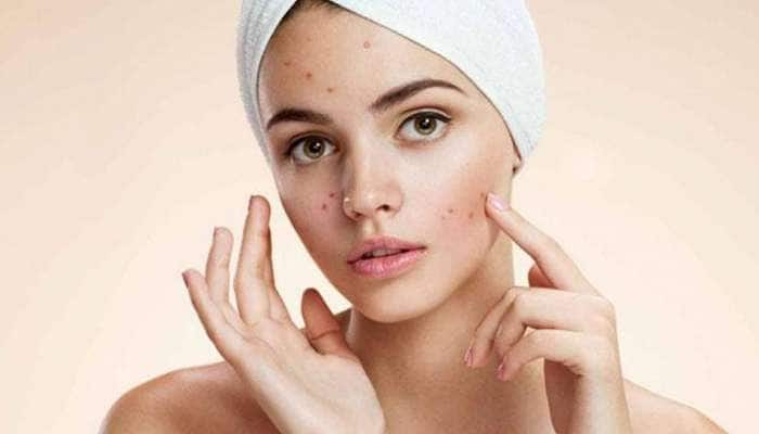 Beauty Tips: முகத்தழும்புகளை ஒரே வாரத்தில் நீக்க வேண்டுமா? இதோ உங்களுக்கான டிப்ஸ்