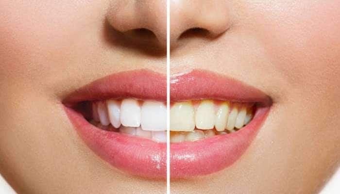 Yellow Teeth: 7 நாட்களில் மஞ்சள் பற்கள் முத்து போல் ஜொலிக்க சில டிப்ஸ்..!!