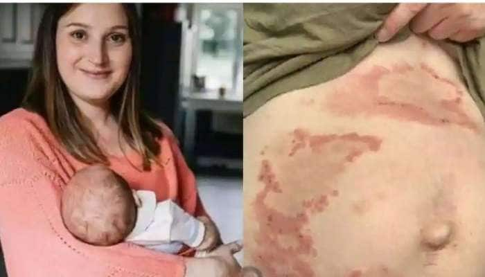 Pregnancy Allergy: பெற்ற குழந்தையே எனக்கு அலர்ஜி! கலங்கும் தாய்