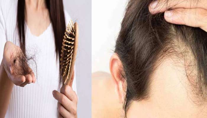 Hair Fall: Try this Mustard Remedy at Home | முடி உதிர்வதால் பிரச்சனையா? கவலை வேண்டாம், கடுகு கடவுளாக வந்து உதவும் | Health News in Tamil Hair Fall: Try this Mustard Remedy at Home | முடி உதிர்வதால் பிரச்சனையா? கவலை வேண்டாம், கடுகு கடவுளாக வந்து உதவும் | Health News in Tamil