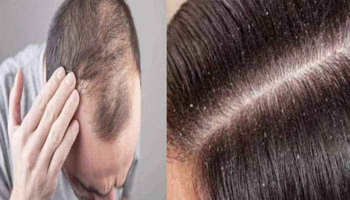 Hair Care Tips: Natural Solution for Hair Fall, Dandruff |  பொடுகுத்தொல்லையா? முடி உதிரும் பிரச்சனையா? இதை செய்து பாருங்கள் | Health  News in Tamil
