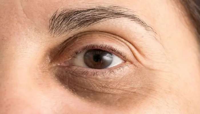 Dark circles: கருவளையங்களை போக்கும் சில எளிய வீட்டு வைத்தியங்கள்