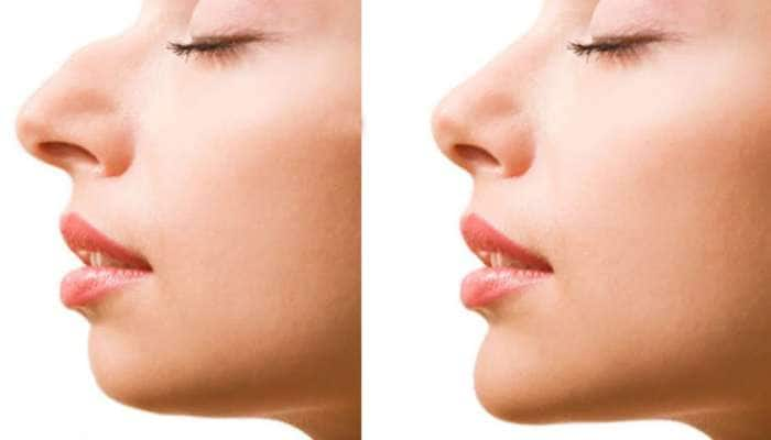 Sharp Nose Tips: கூர்மையான மூக்கு வேண்டுமா? அறுவைச் சிகிச்சை இல்லாமல் பெறலாம் title=