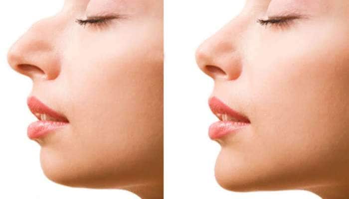 Sharp Nose Tips: கூர்மையான மூக்கு வேண்டுமா? அறுவைச் சிகிச்சை இல்லாமல் பெறலாம்