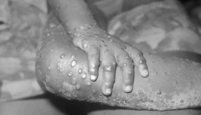 Monkeypox: இங்கிலாந்தில் ஒருவருக்கு தொற்று உறுதி: அறிகுறிகள் இவைதான்