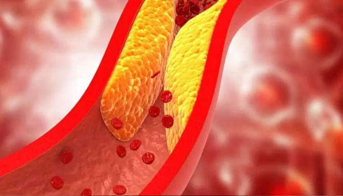 Warning 5 signs of increased cholesterol | கொலஸ்ட்ரால் அதிகரித்து விட்டது  என்பதை உணர்த்தும் 5 எச்சரிக்கை அறிகுறிகள் | Health News in Tamil