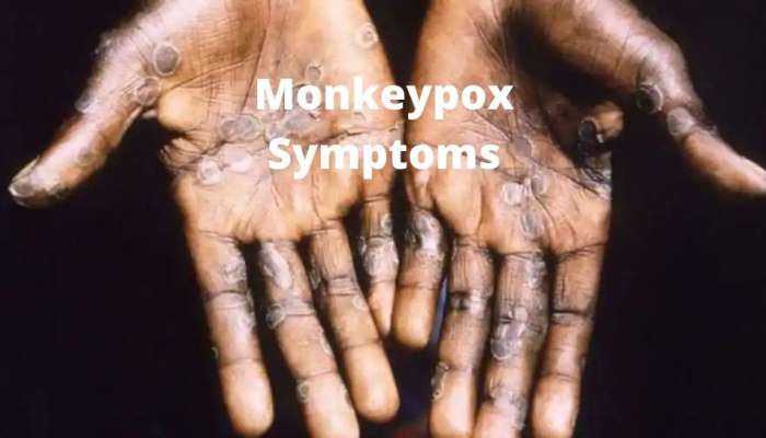 Monkeypox: அதிகரிக்கும் குரங்குக் காய்ச்சல்: அவசரக் கூட்டத்தைக் கூட்டும் WHO title=