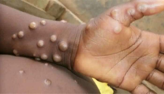 Monkeypox: குரங்கு அம்மை சமூக பரவலாக மாறக் கூடிய அபாயம் உள்ளது; எச்சரிக்கும் WHO title=