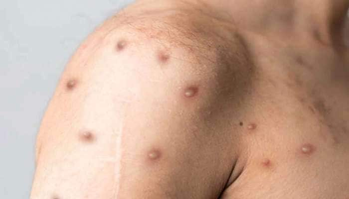 Monkeypox பரவல்; அரசு உயர் எச்சரிக்கை, புதிய அறிகுறிகள் இதுதான்