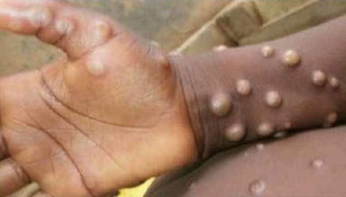 Monkeypox: இவைதான் குரங்கு அம்மையின் முக்கிய அறிகுறிகள்