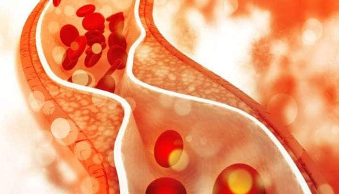 High cholesterol இருந்தால் என்ன ஆகும்; அறிகுறிகள் மற்றும் காரணங்கள் title=