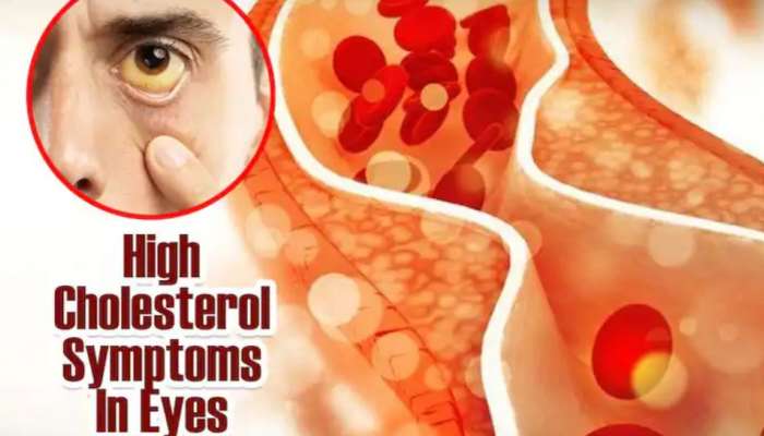 Cholesterol Symptoms: கண்ணில் காதல் மட்டும்தான் தெரியுமா? கொலஸ்ட்ராலும் தெரியலாம்