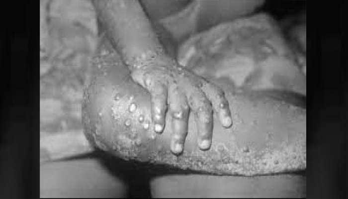 Monkeypox: வேகமாக பிறழும் குரங்கு அம்மை வைரஸ்; WHO கூறுவது என்ன...  title=