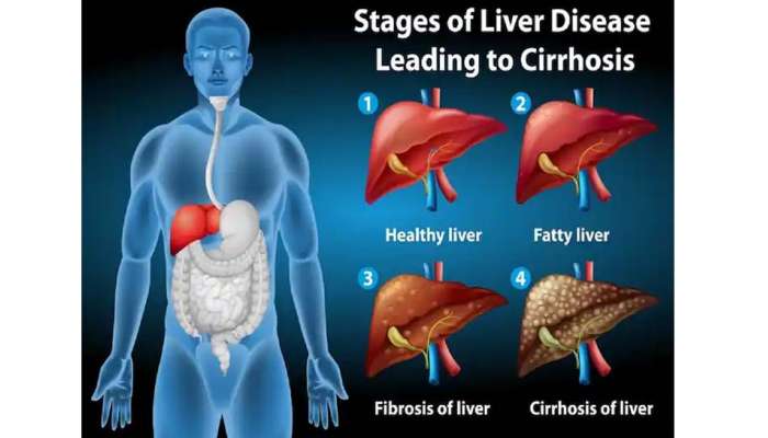 Hepatic steatosis: கல்லீரலில் கொழுப்பு சேர்ந்துவிட்டதா: தவிர்க்க வேண்டிய உணவுகள்