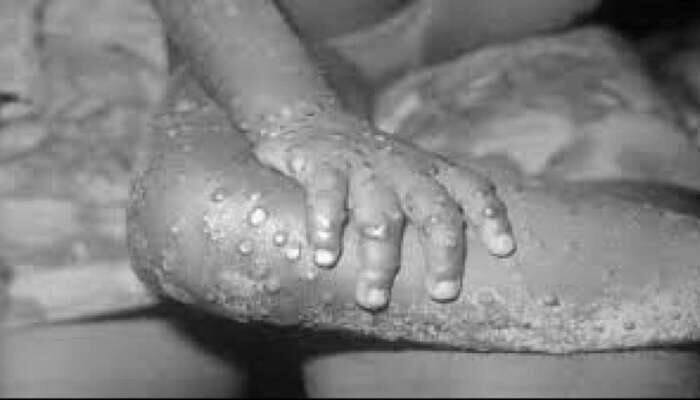 Monkeypox Symptoms: இங்கிலாந்தில் பாலியல் கிளினிக்குகள் மூலமாக குரங்கு அம்மை நோய்