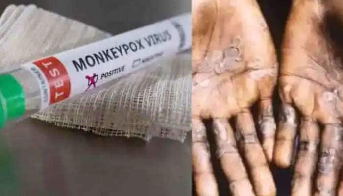 MonkeyPox Spread: பெரியம்மை ஒழிப்புக்கும் குரங்கு அம்மை நோய்க்கும் உள்ள தொடர்பு என்ன