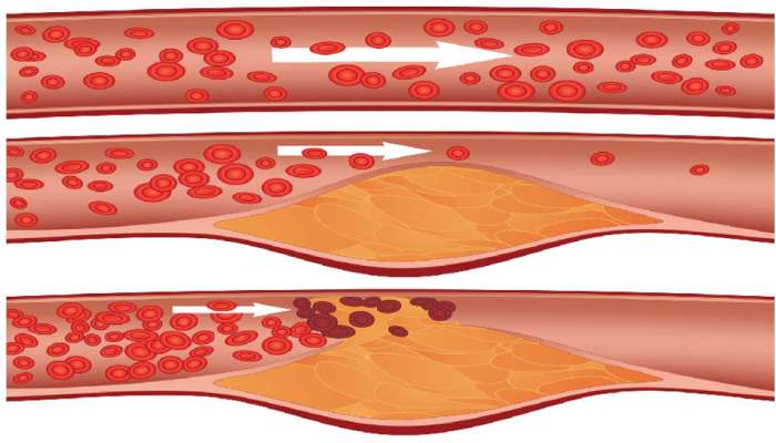 Cholesterol பிரச்சனையா? இதை குடித்தால் ஒரே மாதத்தில் கொழுப்பு பனியாய் உருகும் title=